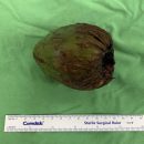 Man in Taiwan gets coconut stuck in rectum, visits hospital after he struggles to pee