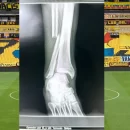 ¡Escalofriante! Radiografía muestra cómo quedó un hueso de Joao Rojas, quien sufrió una fuerte lesión durante el partido contra Sao Paulo (FOTO)